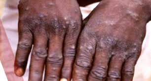 MonkeyPox hits Lagos, two cases reported